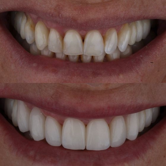 Caso 2 de reabilitação na Oral Unic Capão da Canoa: sorriso antes e depois do tratamento