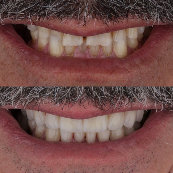 Caso 4 de reabilitação na Oral Unic Capão da Canoa: sorriso antes e depois do tratamento