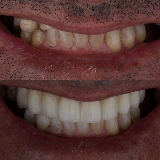 Caso 8 de reabilitação na Oral Unic Capão da Canoa: sorriso antes e depois do tratamento