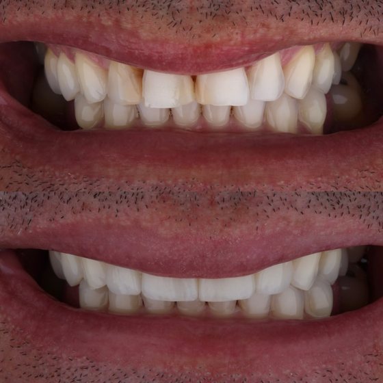 Caso 9 de reabilitação na Oral Unic Capão da Canoa: sorriso antes e depois do tratamento